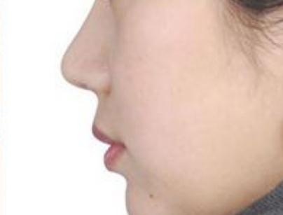 做个假体鼻子大概要多久可以恢复(做个假体鼻子，大概要多久可以恢复)