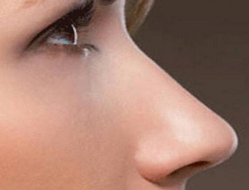 鼻子用膨体会保持多久_做鼻子影响到眼睛了怎么办