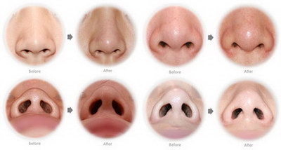 鼻子大小标准(关于鼻子大小是长相的标准的问题)