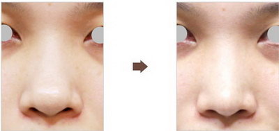 硅胶隆鼻取出过程
