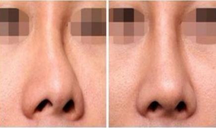 鼻子鼻翼不对称(鼻翼不对称的原因及治疗方法)