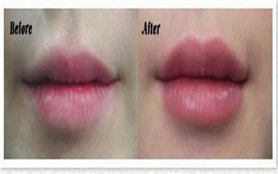 嘴唇补色后需要注意什么_缩嘴唇手术前后对比照图