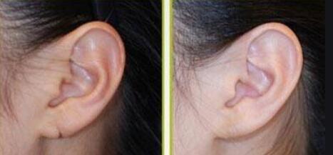 小耳畸形做耳再造哪位医生技术好
