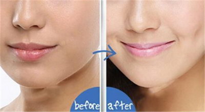 下巴能改善脸型吗_蒜头鼻整形手术:改善脸型、重塑面部美观