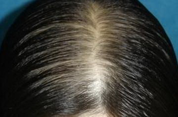 男性脱发1-7级程度图片