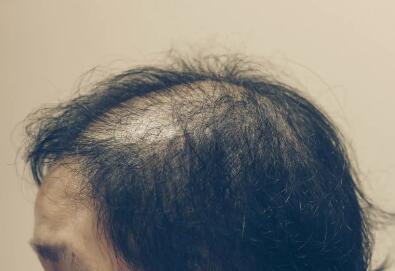 脂溢性脱发怎么根治_中医论治脂溢性脱发的四种方法