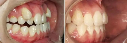 牙齿有小洞怎么预防(牙齿表面有个小洞怎么办不是龋坏)