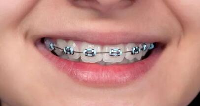 多颗牙齿缺失修复方法