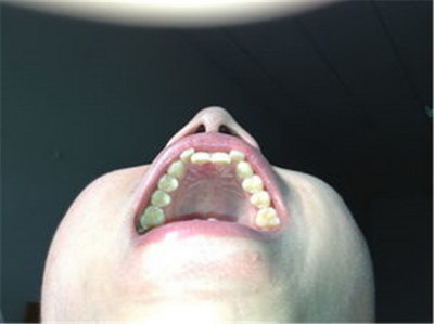 铸瓷贴面牙齿能维持多少年_陶瓷贴面牙齿能维持多久