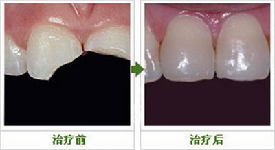 大牙做完根管治疗怎么做牙冠_大牙根管治疗后两年牙疼