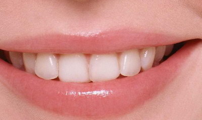 如果是骨性的,牙齿矫正改变大吗