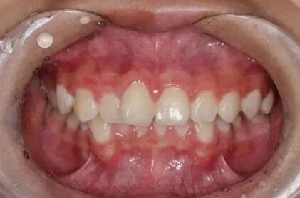 铸瓷贴面牙齿能维持多少年_陶瓷贴面牙齿能维持多久