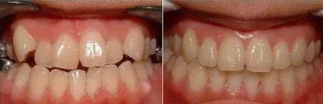牙缝变大怎么治疗