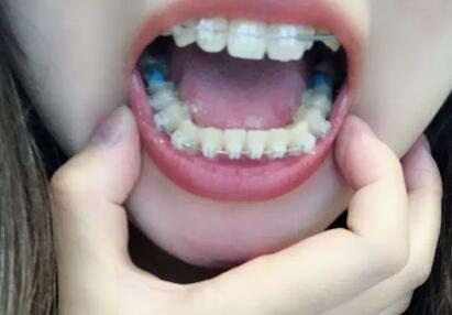 种植牙齿的寿命是多少年(种植牙齿寿命多少年？)