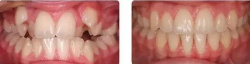 人的正常牙齿是多少颗(成年人正常牙齿)
