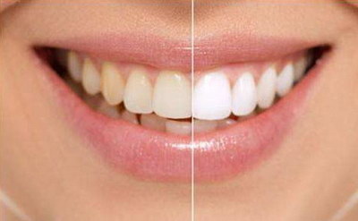 矫正牙齿哪种牙套效果好_嘴凸矫正牙齿前后对比