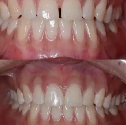 怎样可以修复蛀牙牙齿_德国纳米美白牙齿贴面