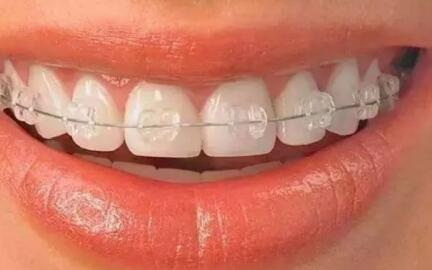 怎么治牙齿龅牙_有点龅牙能整吗