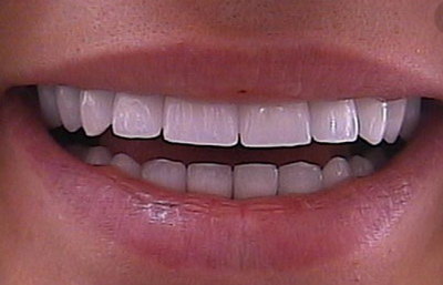 刷牙不当导致牙龈萎缩