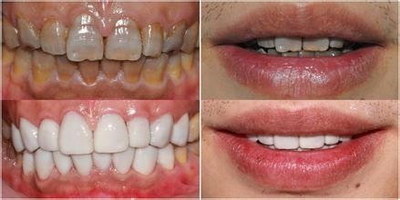 乳牙滞留的原因有哪些_乳牙滞留的原因可能是