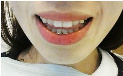 氟斑牙怎么样能变白