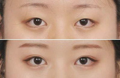 一只眼单眼皮一只眼双眼皮的人(如何搭配化妆品让单双眼皮更加协调？)