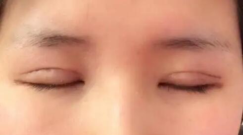 刚做好的双眼皮图片_韩式无痕双眼皮:减少痕迹，获得美丽容颜