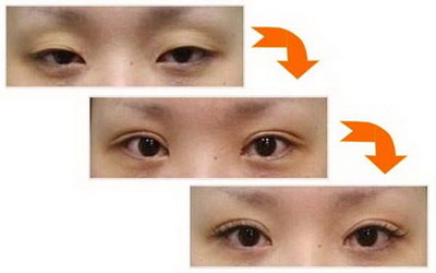 广州双眼皮手术更好的医生