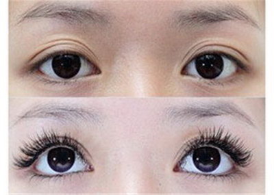 全切双眼皮疤痕增生期是什么时候_全切双眼皮疤痕增生多久可以恢复