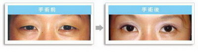 双眼皮手术方式选择_双眼皮手术宽度选择