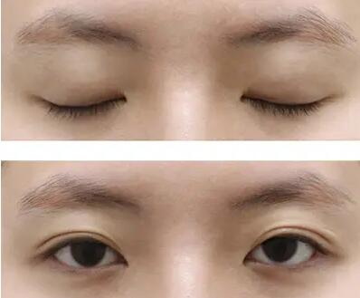 双眼皮手术多久能化眼妆(术后第1天)