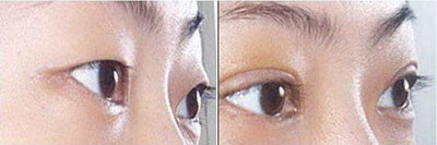 切开双眼皮手术适合哪些人群？