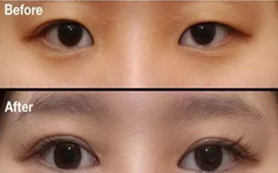 眼睑下垂多少算正常_眼睑下垂的原因和治疗