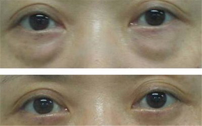 双眼皮手术后多久可以重新做修复_双眼皮手术后多久可以做修复手术