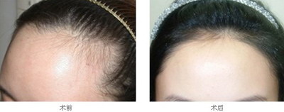 全头头发稀疏是什么原因_内分泌失调导致头发稀疏