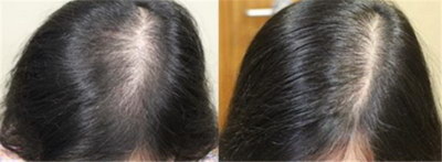 广州哪些医院可以植发_植发能够维持多久