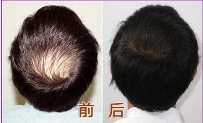 种植头发可以保持几年_种植头发哪家好