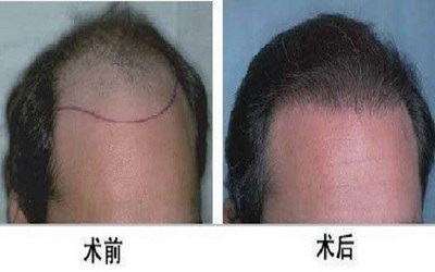 植发效果能保持几年_济南雍禾植发院长