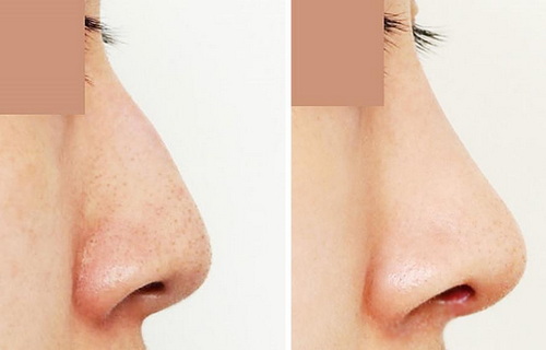 整形鼻头缩小手术过程_不取假体可以鼻头缩小吗