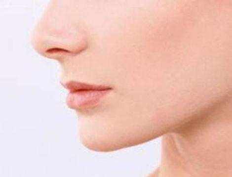 鼻子打玻尿酸能维持多少年？