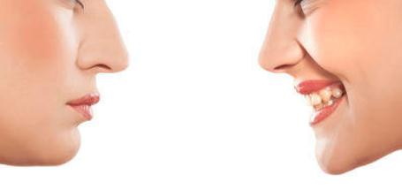 肤质之分：鼻翼两侧与嘴角干的差异_脸颊鼻翼两侧发黑是怎么回事