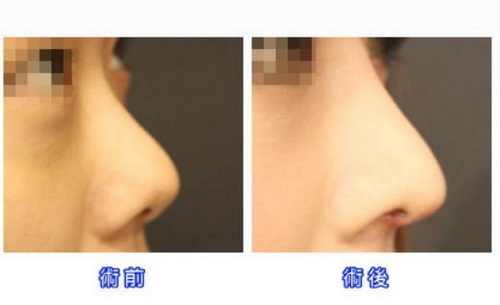 鼻头肥大自然缩小_鼻头缩小术对鼻头肥大效果好吗