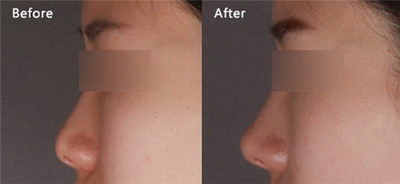 鼻头缩小手术副作用_鼻头缩小手术的原理