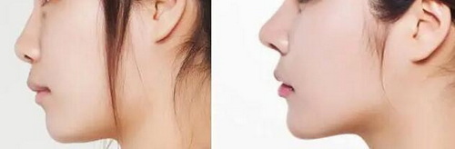 鼻综合一个月和3个月鼻头变化_鼻综合一个月和三个月区别