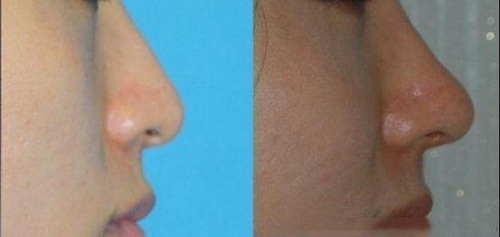 鼻子玻尿酸永久性整容：它能帮助你拥有完美的鼻子