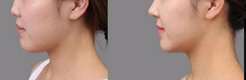 隆鼻安全性高、持久效果佳的方法选择_准备接受隆鼻手术前的注意事项