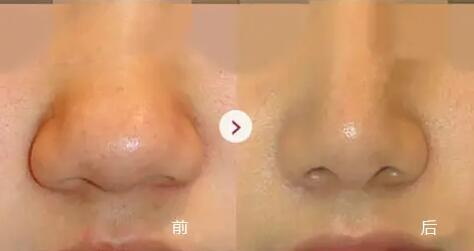 综合鼻整形失败后多久能取出假体_综合鼻整形鼻头红肿