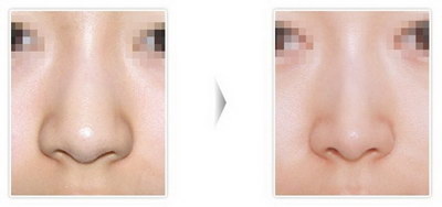 线雕鼻子几天能自然恢复(手术后24小时内)