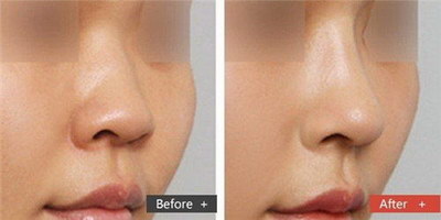鼻综合隆鼻哪个好(如何选取鼻综合隆鼻方式？)