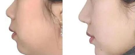 如何塑造完美的Lisa鼻子?_怎样护理鼻子?